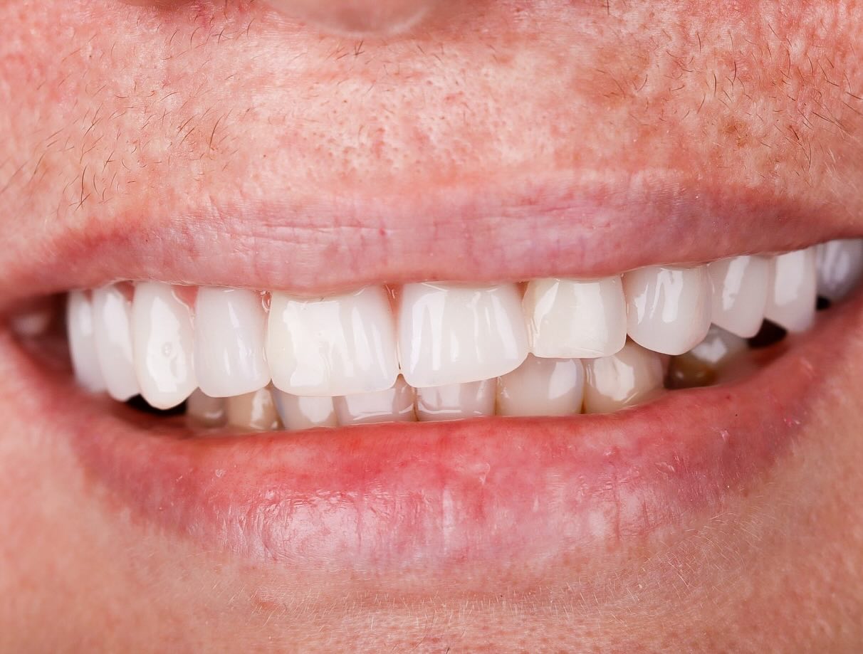 Foto do sorriso da paciente Cleide depois do tratamento.