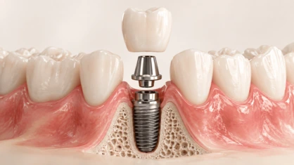 Implante dentário em corte anatômico com coroa sobre o osso