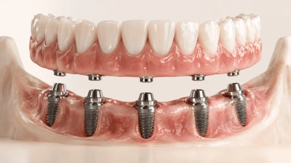 Prótese protocolo completa fixada sobre implantes dentários
